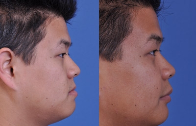 before and after orthognathic surgery male patient right side view case 2562