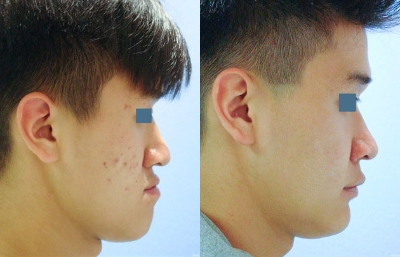 before and after orthognathic surgery male patient right side view case 2569