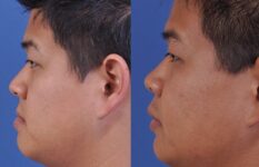 before and after orthognathic surgery male patient left side view case 2562