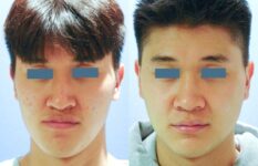 before and after orthognathic surgery male patient front view case 2569