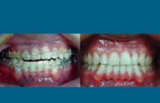 before and after orthognathic surgery front view case 2569