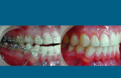 before and after orthognathic surgery closeup on right side of mouth case 2569
