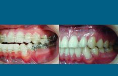 before and after orthognathic surgery closeup on mouth case 2569