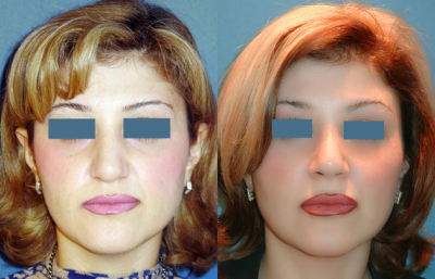 before and after revision rhinoplasty female patient front view case 2271