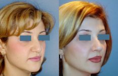 before and after revision rhinoplasty female patient right angle view case 2271