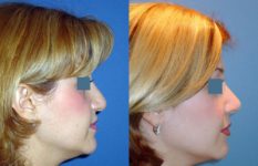 before and after revision rhinoplasty female patient right side view case 2271