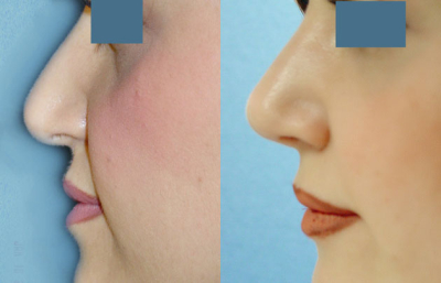 before and after revision rhinoplasty female patient left side view case 2271