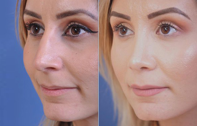 before and after rhinoplasty female patient left angle view case 2055