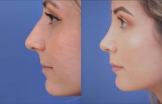 before and after rhinoplasty female patient left side view case 2055
