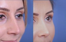 before and after rhinoplasty female patient right angle view case 2055