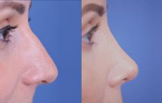 before and after rhinoplasty female patient right side view case 2055