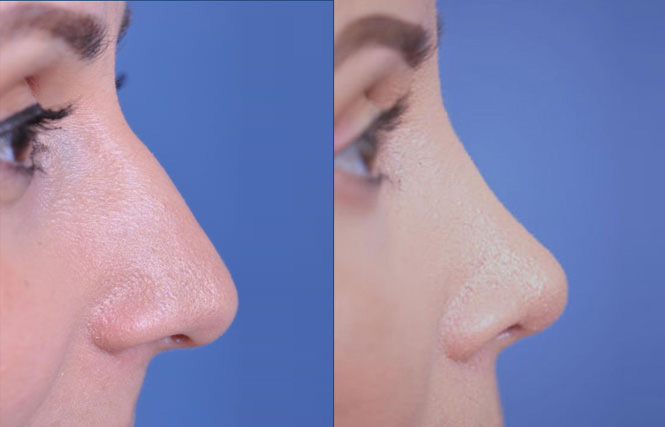 before and after rhinoplasty female patient right side view case 2055