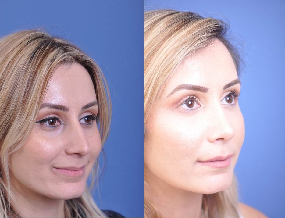 before and after rhinoplasty female patient right angle view case 2055