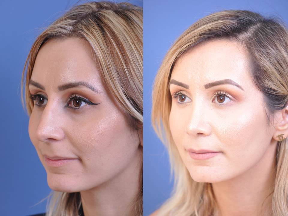 before and after rhinoplasty female patient left angle view case 2055