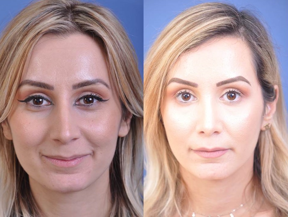 before and after rhinoplasty female patient front view case 2055