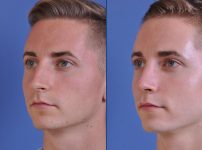 before and after rhinoplasty male patient left angle view case 2078