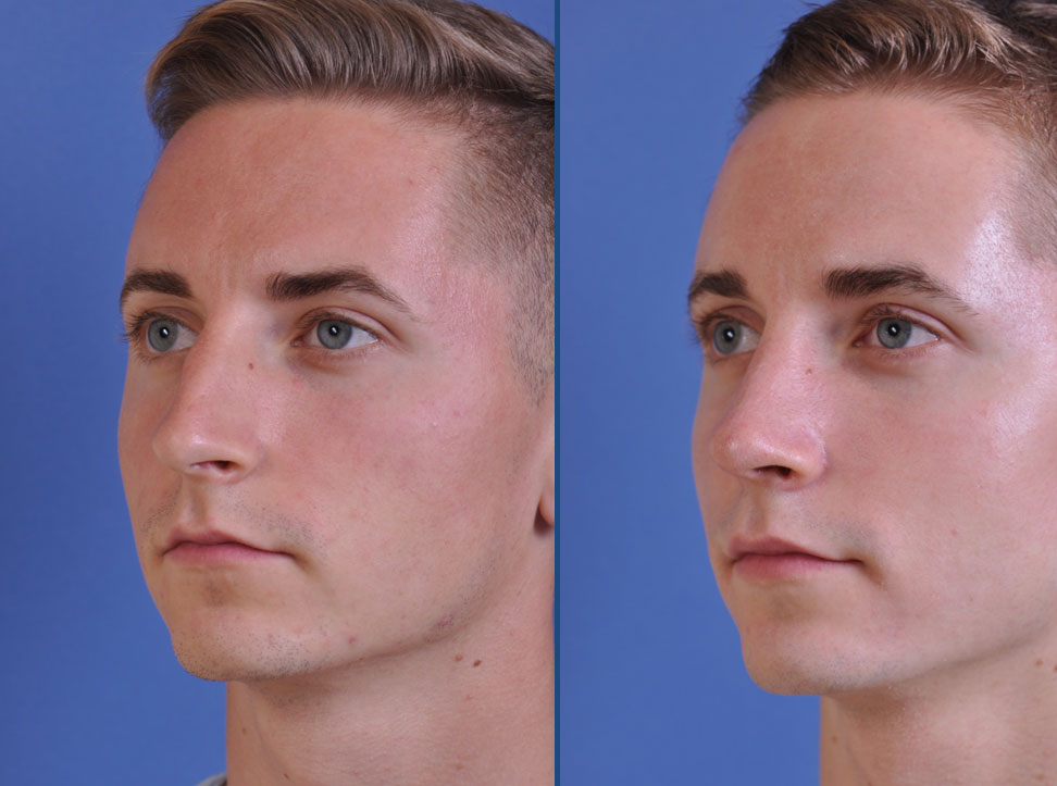 before and after rhinoplasty male patient left angle view case 2078