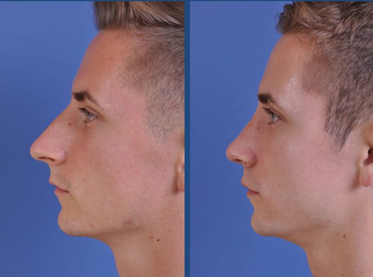 before and after rhinoplasty male patient left side view case 2078