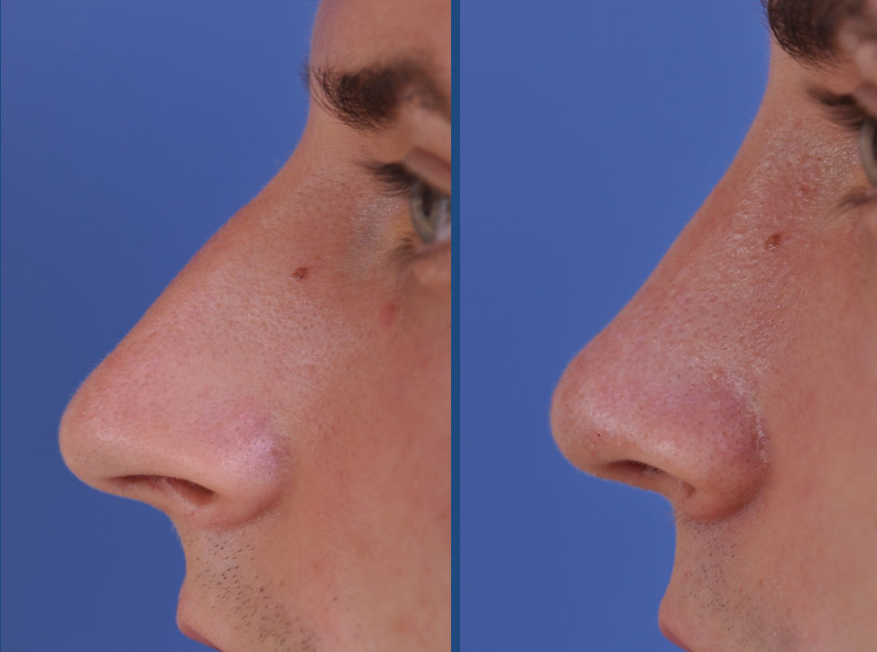 before and after rhinoplasty male patient left side view case 2078