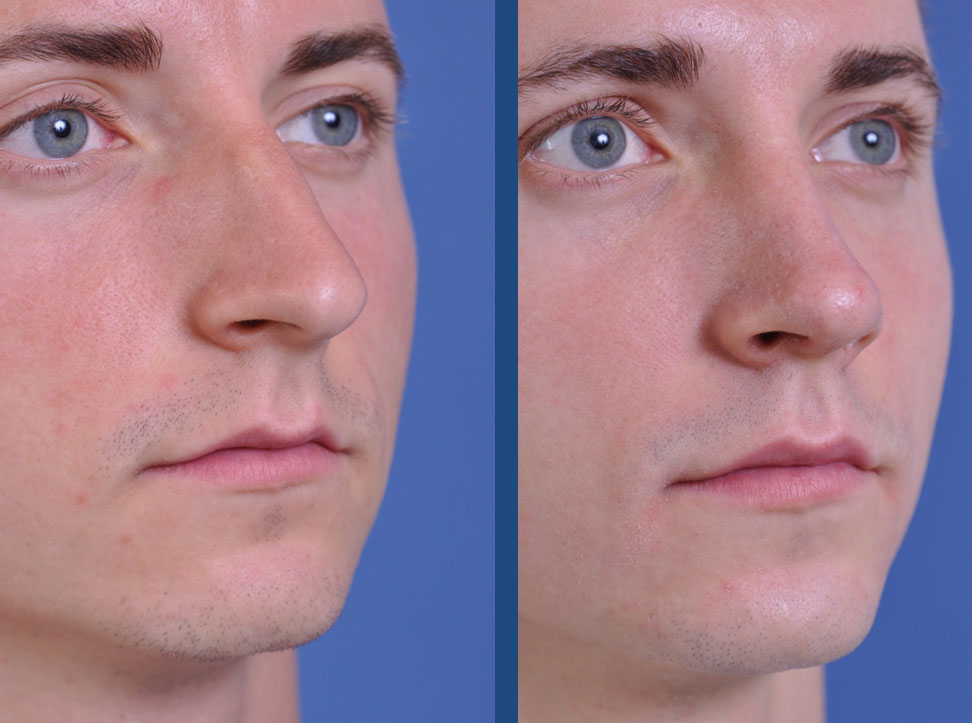 before and after rhinoplasty male patient right angle view case 2078
