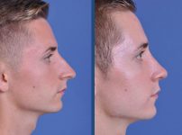 before and after rhinoplasty male patient right side view case 2078