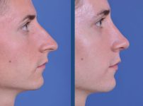 before and after rhinoplasty male patient right side view case 2078