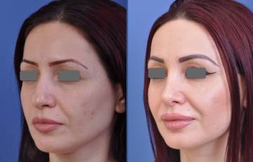 before and after rhinoplasty female patient left angle view case 2088