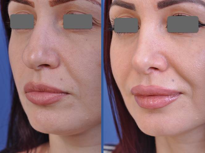 before and after rhinoplasty female patient left angle view case 2088
