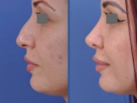 before and after rhinoplasty female patient left side view case 2088