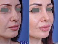 before and after rhinoplasty female patient right angle view case 2088
