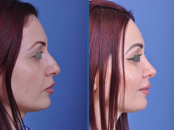 before and after rhinoplasty female patient right side view case 2088
