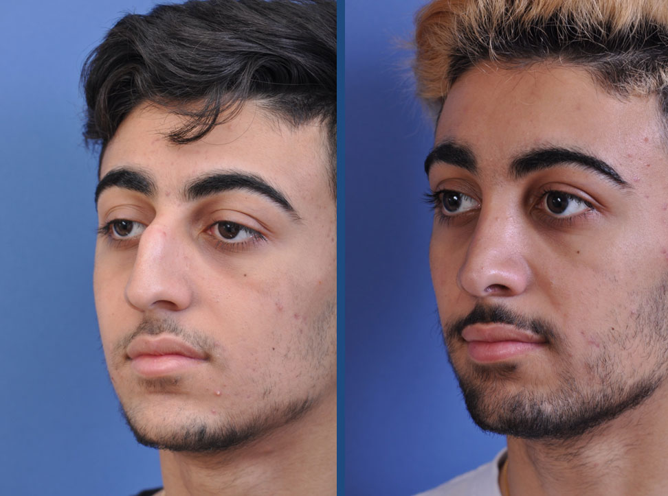 before and after rhinoplasty male patient left angle view case 2098
