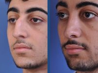 before and after rhinoplasty male patient left angle view case 2098