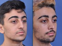 before and after rhinoplasty male patient right angle view case 2098