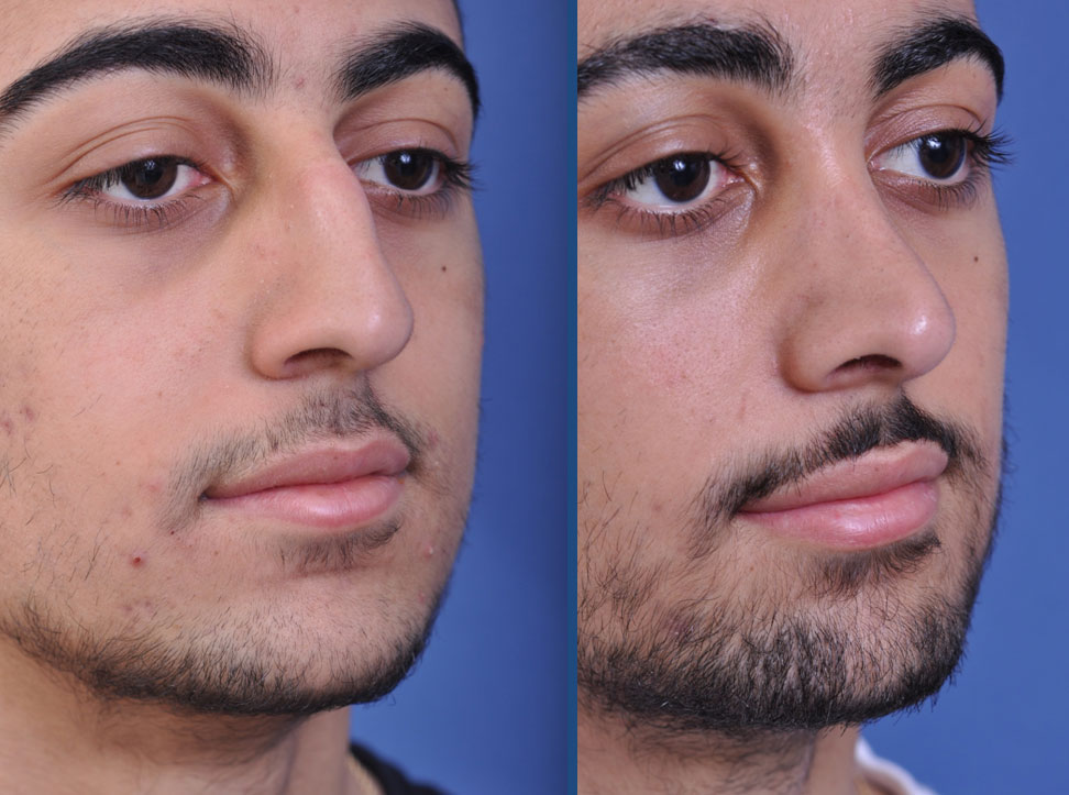 before and after rhinoplasty male patient right angle view case 2098