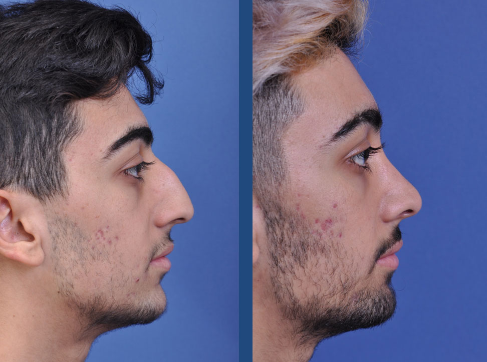 before and after rhinoplasty male patient right side view case 2098