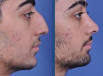 before and after rhinoplasty male patient right side view case 2098