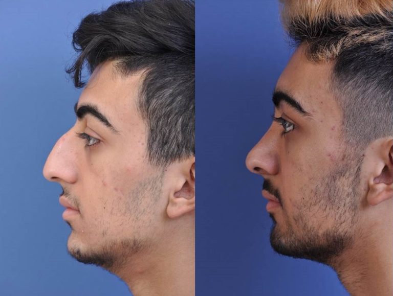 before and after rhinoplasty male patient left side view case 2098