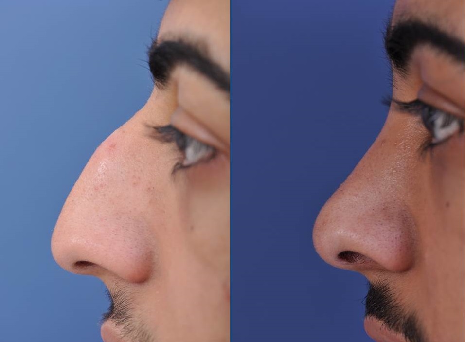 before and after rhinoplasty male patient left side view case 2098