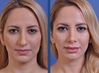 before and after rhinoplasty female patient front view case 2119