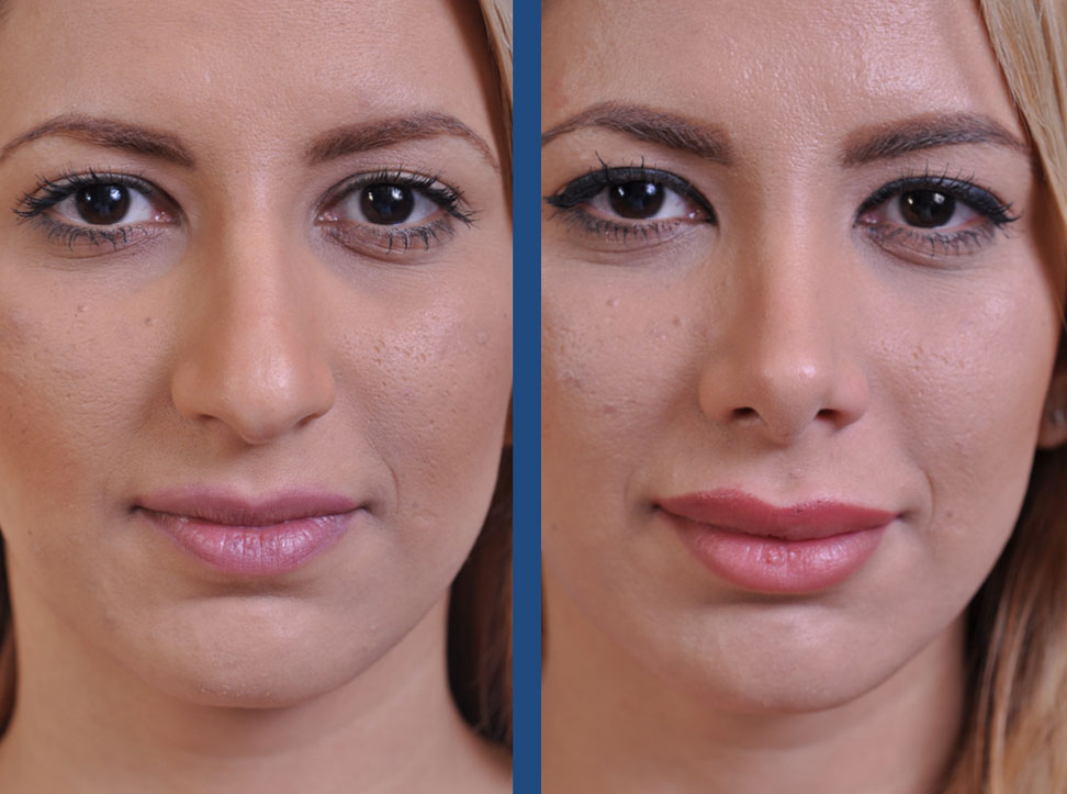 before and after rhinoplasty female patient closeup front view case 2119