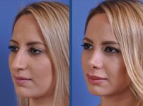 before and after rhinoplasty female patient left angle view case 2119