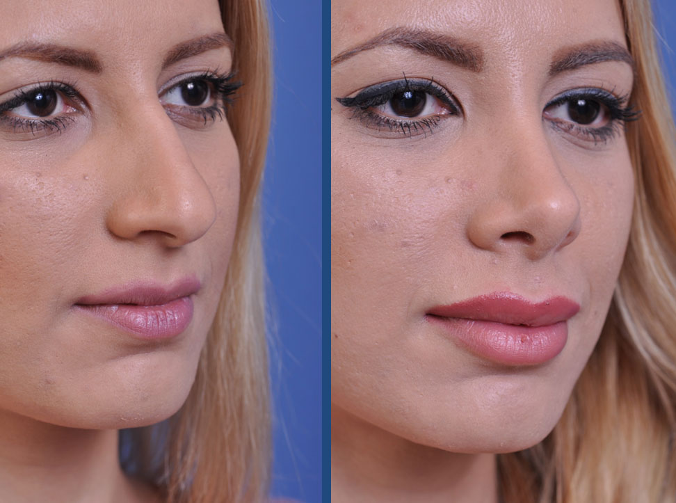 before and after rhinoplasty female patient right angle view case 2119