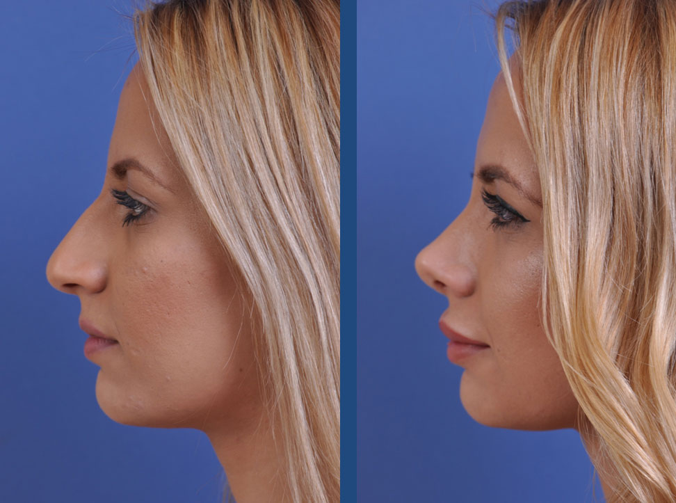 before and after rhinoplasty female patient left side view case 2119