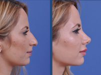 before and after rhinoplasty female patient right side view case 2119