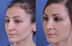 before and after rhinoplasty female patient left angle view case 2139