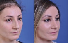 before and after rhinoplasty female patient right angle view case 2139