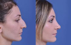 before and after rhinoplasty female patient right side view case 2139