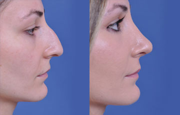 before and after rhinoplasty female patient right side view case 2139