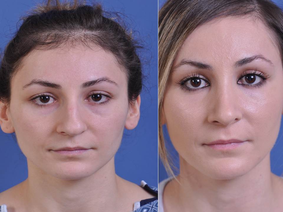 before and after rhinoplasty female patient front view case 2139